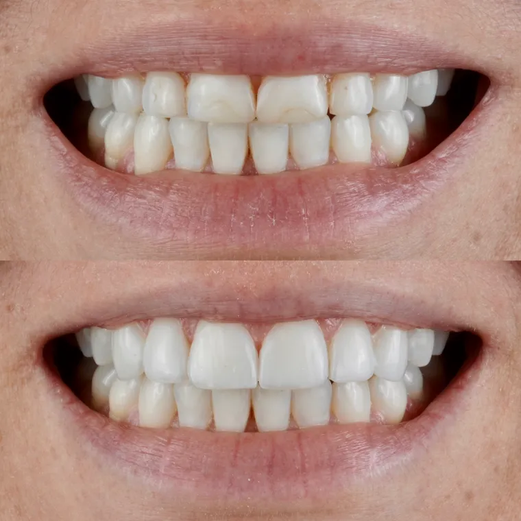Resultado de tratamento odontológico — sorriso de paciente do Dr. João Vicente