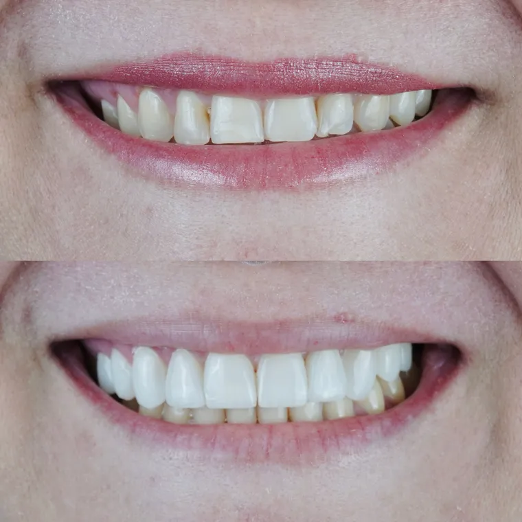 Sorriso restaurado de paciente após tratamento com o Dr. João Vicente