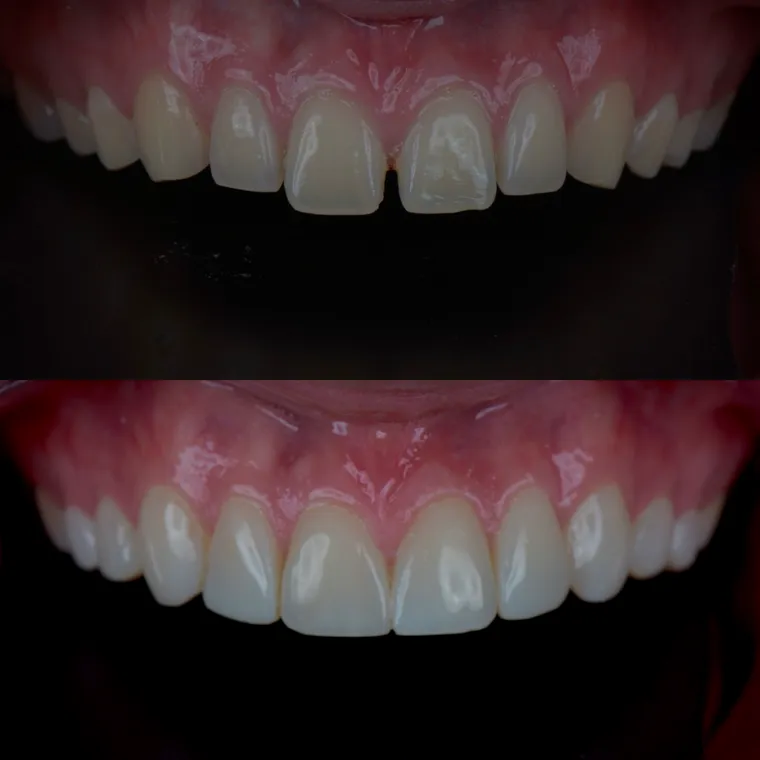 Resultado de implante dentário em paciente do Dr. João Vicente
