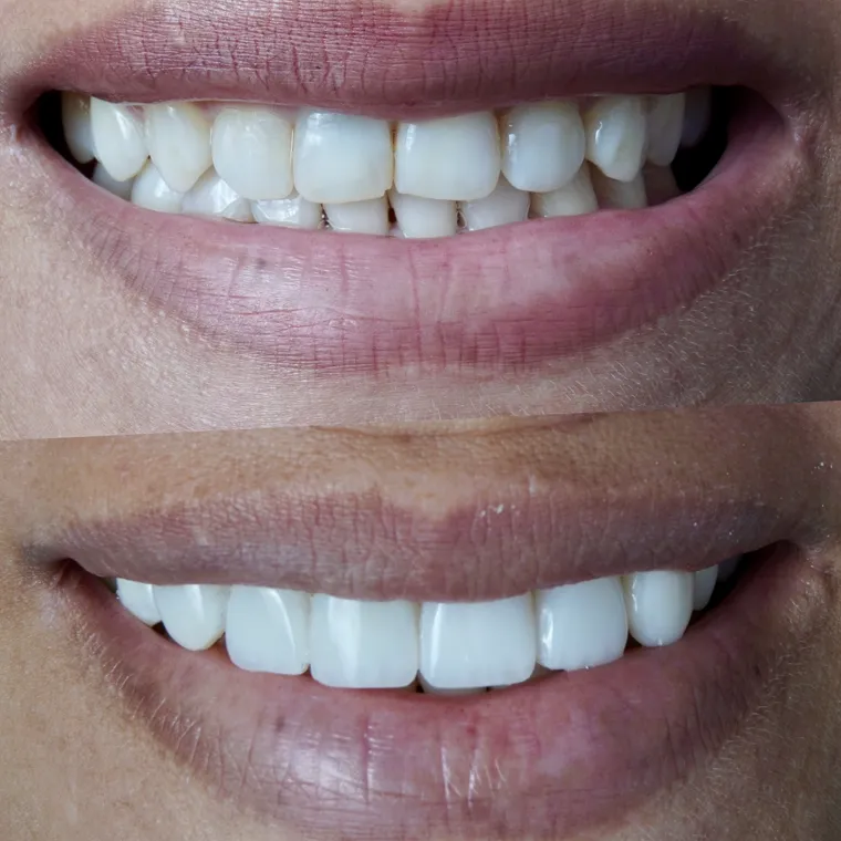 Sorriso harmonizado após tratamento odontológico em Itapema