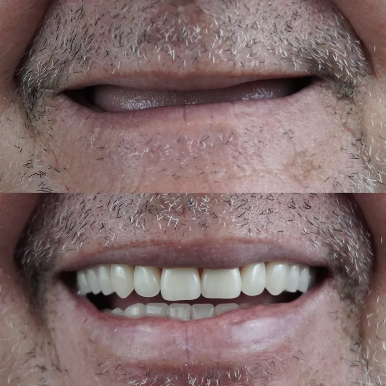 Sorriso recuperado após tratamento odontológico com o Dr. João Vicente