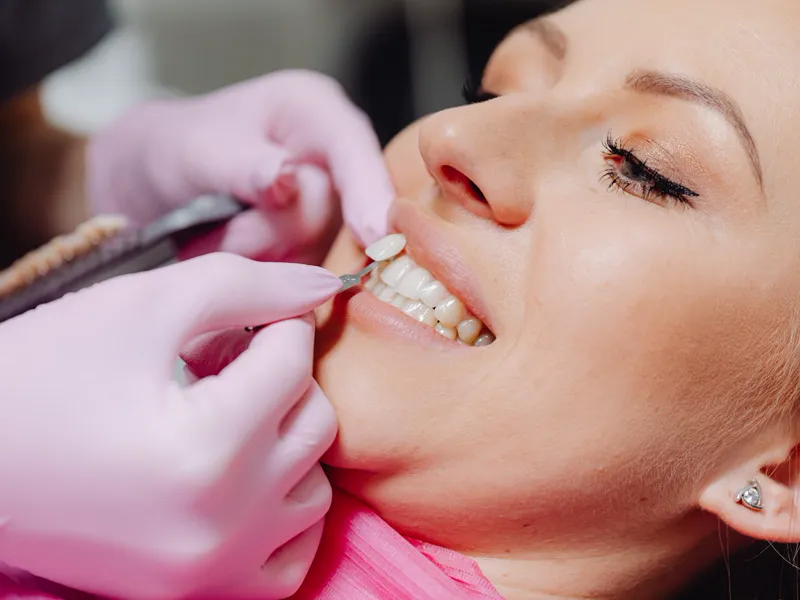 Facetas de porcelana aplicadas para harmonização do sorriso