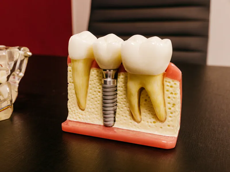 Implante dentário sendo posicionado para repor um dente ausente