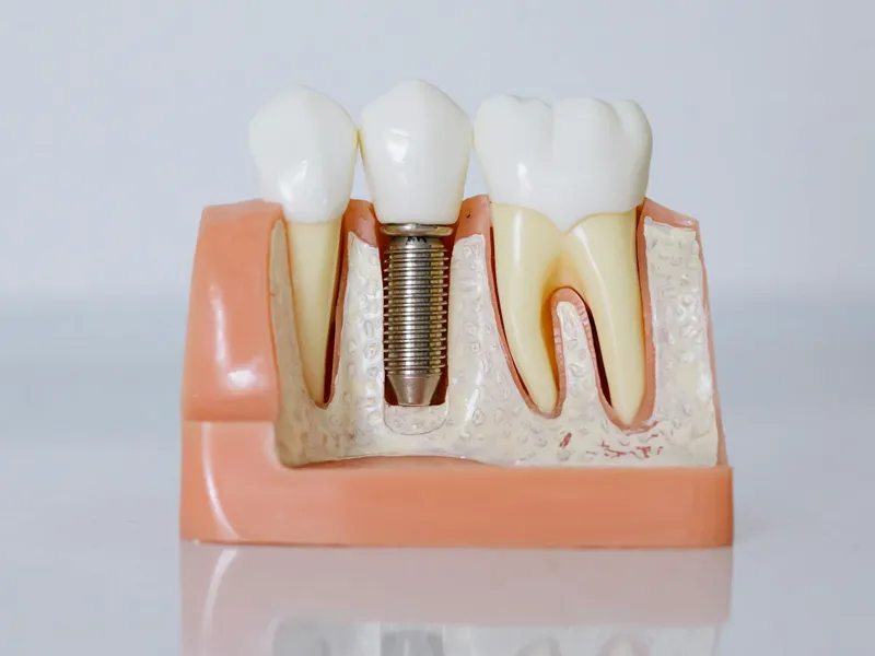 Prótese dentária fixa instalada sobre dente preparado